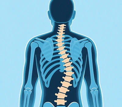 Scoliosis: Xianku 3D Body Scanner, 3D+AI, Scoliosis Prevention And Correction