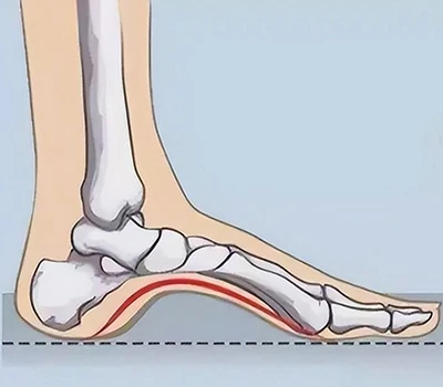 Navigating High Arches: Understanding The Condition And Innovative Solutions With 3D Foot Scannin...
